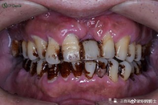 罗斯福咬紧他的牙根