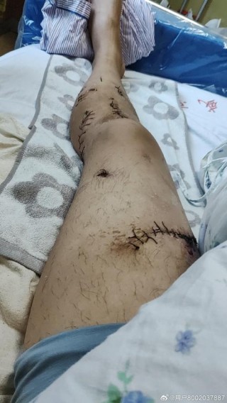 腿腿被刺事件“背后”