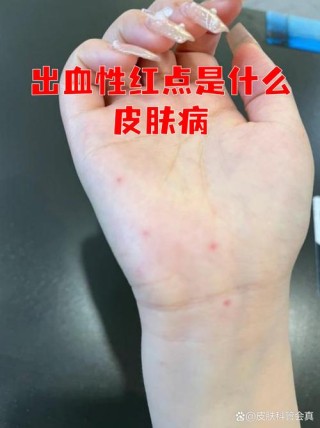 皮肤血液渴求症