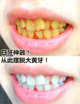 美白牙齿小妙招，让你轻松告别大黄牙