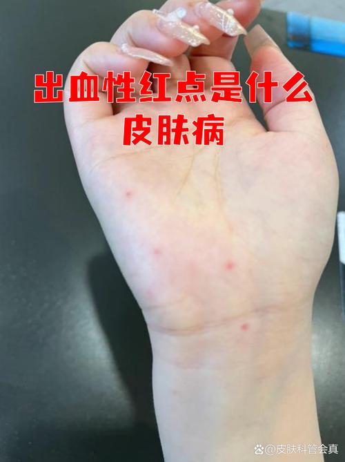 皮肤血液渴求症  第1张