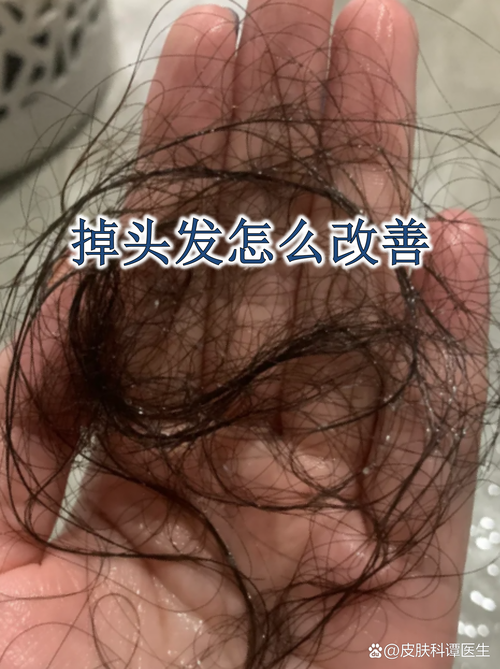 夏季容易掉头发，四招帮你预防脱发  第1张