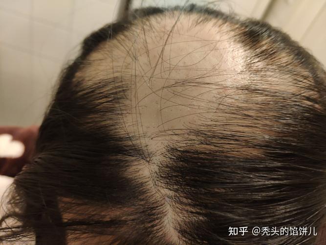 秃头饭后走 （打一字）  第1张